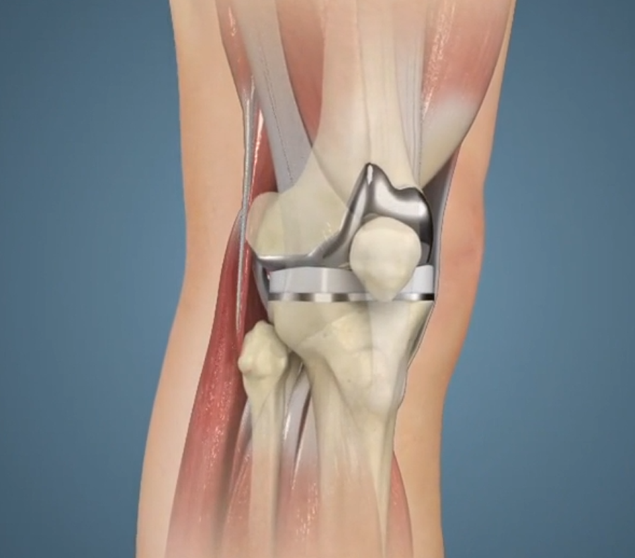 knee--replacement-services-dr-vinay-ortho
