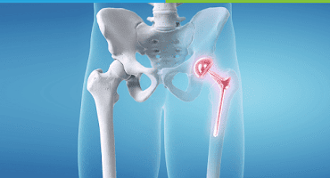 Freedom from Pain: Top Benefits of Hip Replacement Surgery