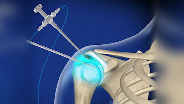 Think You Know Shoulder Arthroscopy? Debunks Common Myths