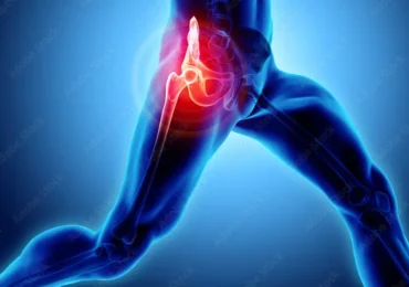 What Is the Fastest Way to Recover from a Hip Replacement? Proven Tips for Quick Healing