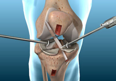 How Long Does It Take to Recover From ACL Reconstruction?